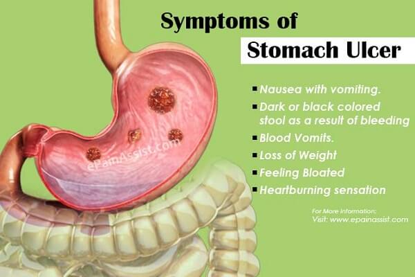 Viêm loét dạ dày tiếng anh là gì: stomach ulcers