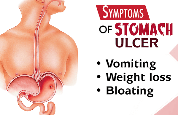 Viêm loét dạ dày tiếng anh là gì: stomach ulcers
